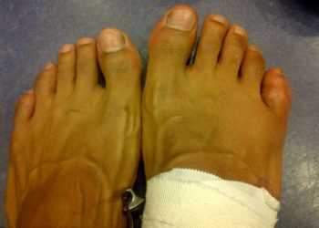 Девід Хей: Я боксував зі зламаним пальцем на нозі