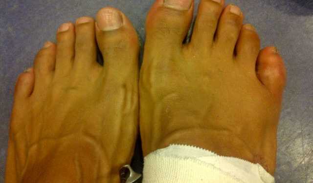 Девід Хей: Я боксував зі зламаним пальцем на нозі