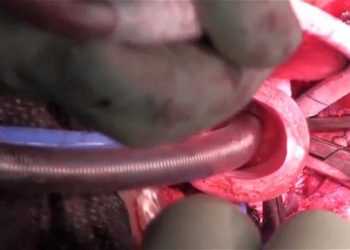 Перша в світі пересадка штучного органу