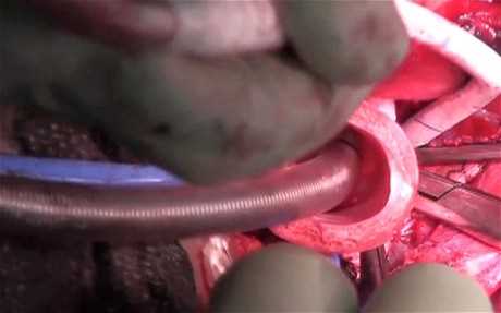 Перша в світі пересадка штучного органу