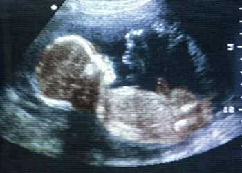 Раді Європи запропонували заборонити дізнаватися стать плоду під час вагітності