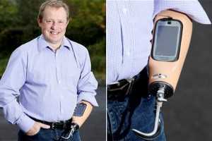 Британець вмонтував в руку телефон