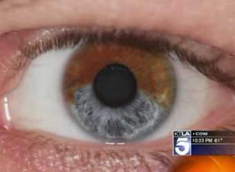 Лазер допоможе змінити карий колір очей на блакитний