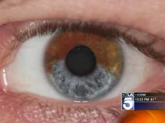 Лазер допоможе змінити карий колір очей на блакитний