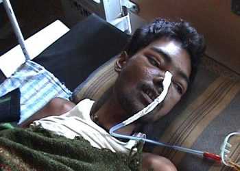 В Індії помер пацієнт з 6 кг металу у шлунку