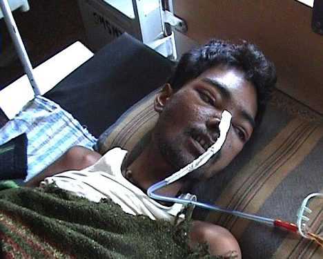 В Індії помер пацієнт з 6 кг металу у шлунку