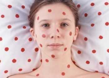 В Івано-Франківській області немає епідемії кору