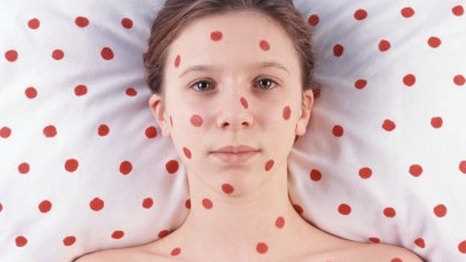 В Івано-Франківській області немає епідемії кору