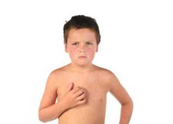 В Львівській області ще 30 випадків кору