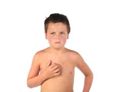 В Львівській області ще 30 випадків кору