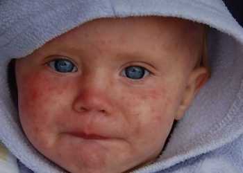 Во Львовской области виявлено 56 новых случав заболевания корью