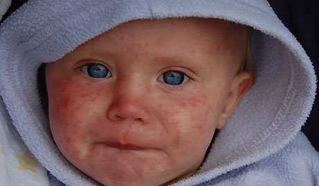 Во Львовской области виявлено 56 новых случав заболевания корью