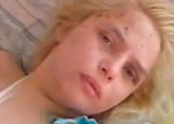В дівчини досі видно слід на шиї від черевика