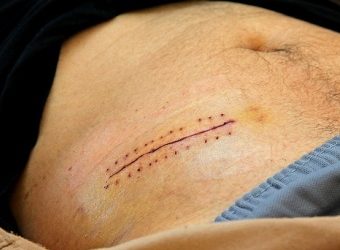 Відрепер гострий апендикс можна вилікувати без операції