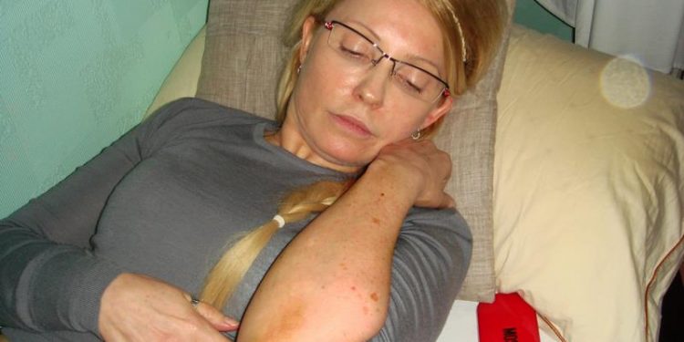 Судебные медики объяснили происхождение синяков Тимошенко