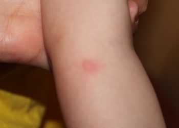 Врачи рассказали, чем опасно заболеть ветрянкой взрослому
