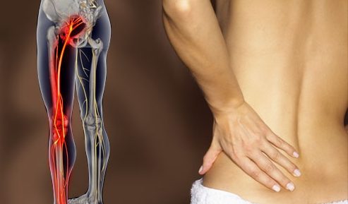 защемление седалищного нерва