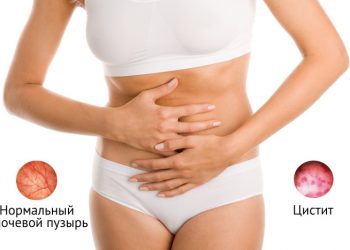 Специалисты рассказали, как избежать цистита и пиелонефрита