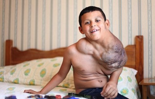 Мальчику удалили опухоль огромных размеров