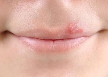 Специалисты посоветовали эффективные средства при герпесе