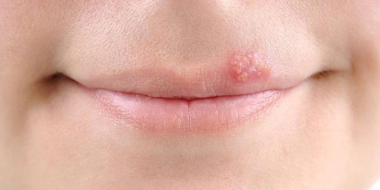 Специалисты посоветовали эффективные средства при герпесе