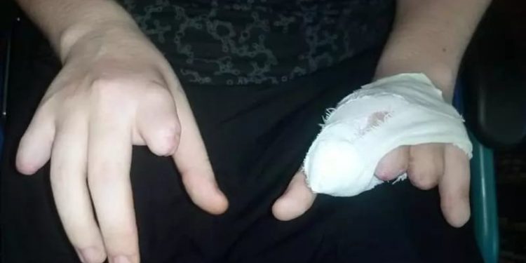 В ДНР «кинули» снайпершу, ставшую после боя инвалидом