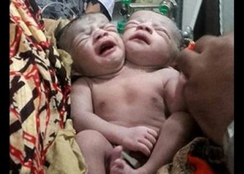 В Бангладеш родилась девочка с двумя головами