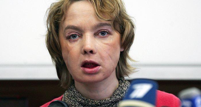 Во Франции умерла первая в мире женщина с пересаженным лицом